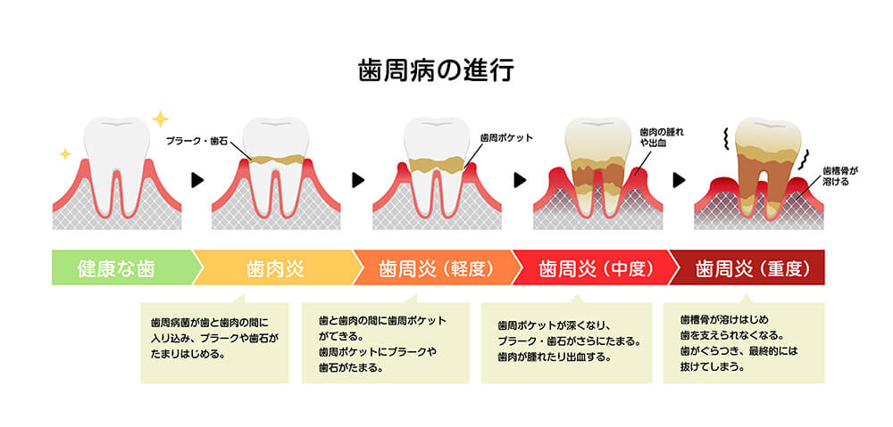 歯周病の進行