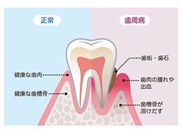 歯周外科治療