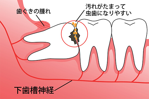 親知らずを抜いた方がいい場合の生え方